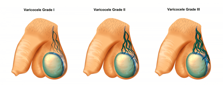 varicocèle-grades