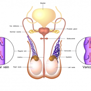 Varicocele of Testis