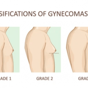 Varicocele Gynecomastia